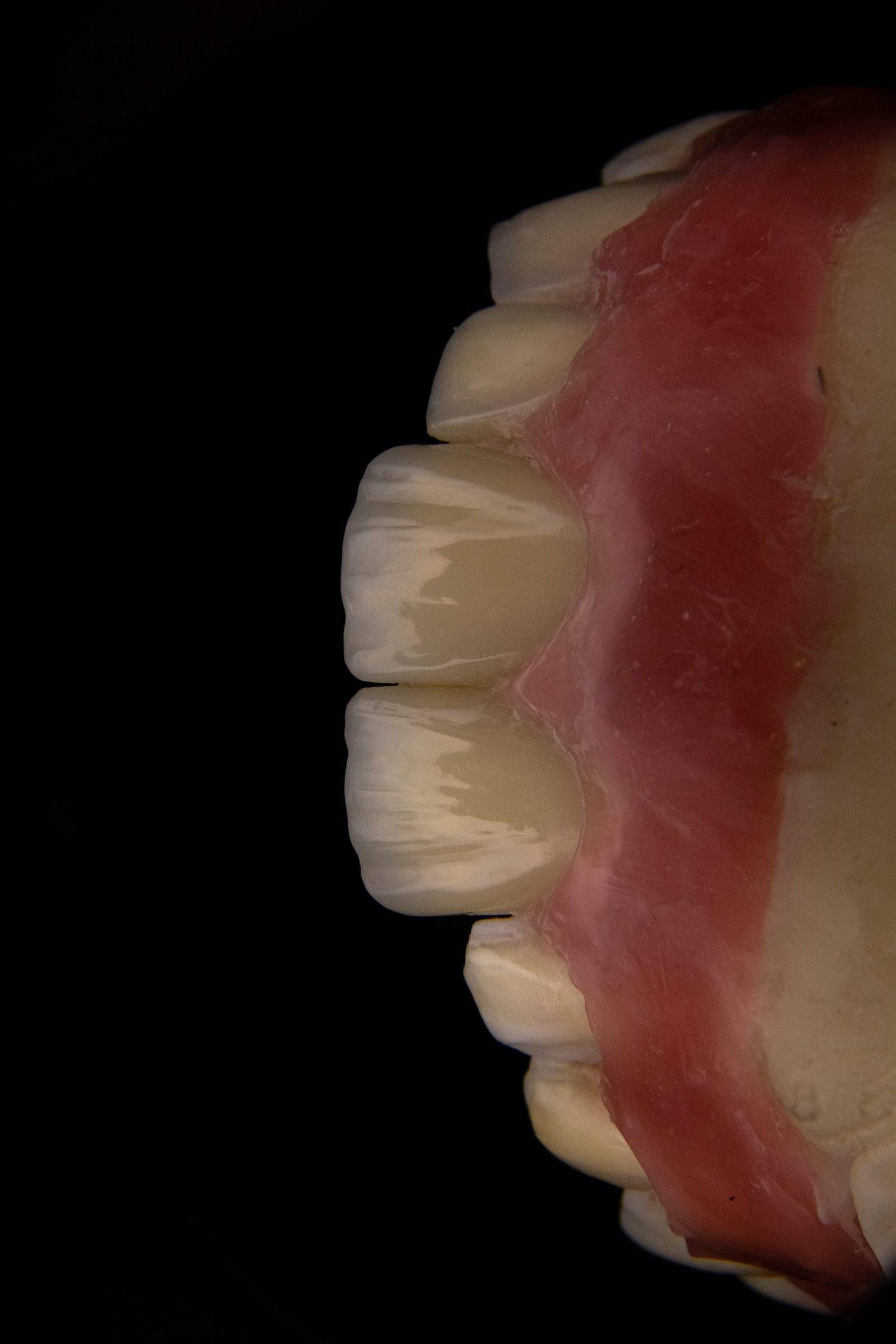Cosmetic dentistry at Zonnelach Rotterdam